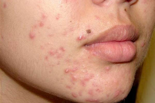 Da mặt tích tụ bụi bẩn là môi trường thuận lợi cho vi khuẩn gây mụn đỏ ở má phát triển