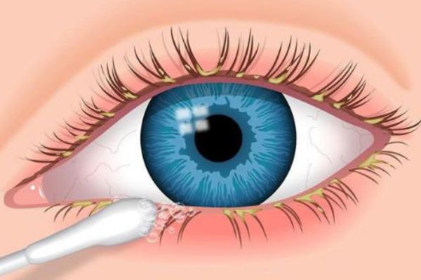 Làm sạch mi mắt sẽ giúp quá trình nối mi an toàn và hiệu quả hơn