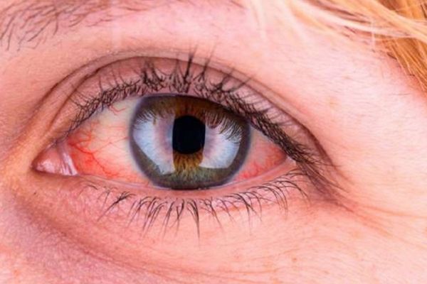 Nối mi bị đỏ mắt: Nguyên nhân, Cách xử lý, Phòng ngừa an toàn
